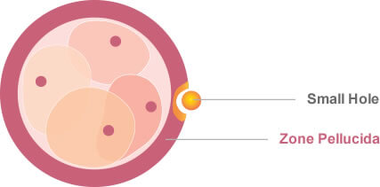Laser Assisted - Alpha IVF Fertility Center Malaysia